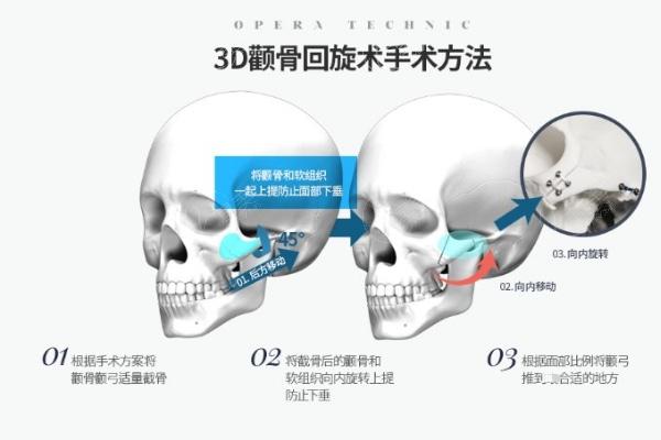 脸部不对称想要改善怎么办