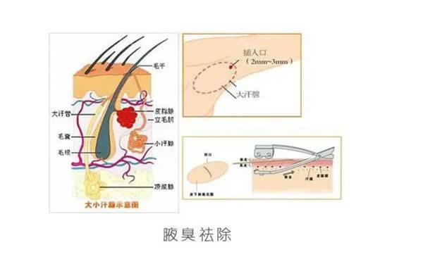 Miradry微波腋臭治疗是否可能达到3万元