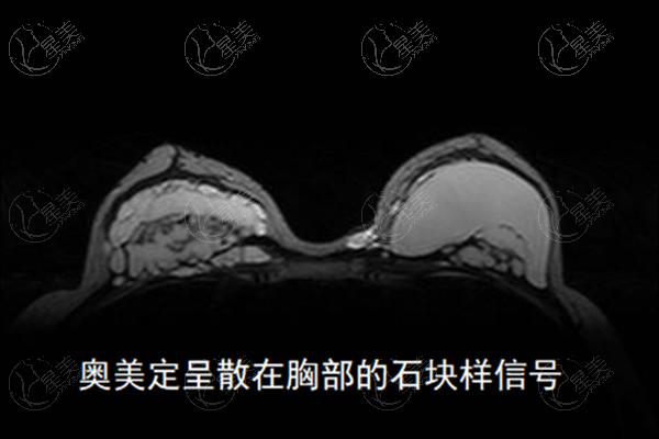 国内异物取出手术多少钱？