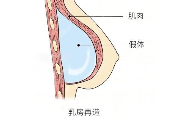 乳房再造手术需要多少钱？