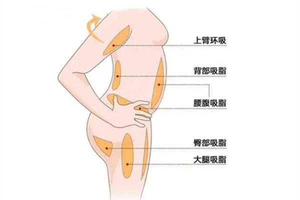 韩国吸脂手术多少钱