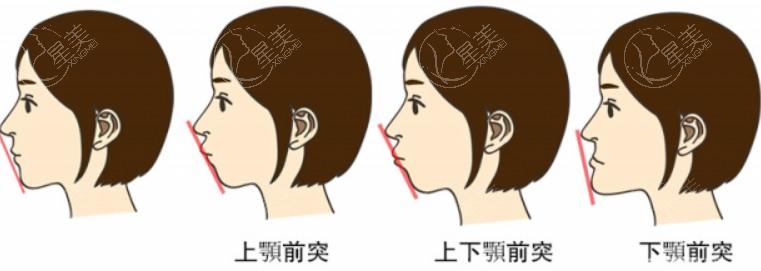 杭州脂肪填充哪家医院便宜又好？星光丽格、艺星、维多利亚位列前三