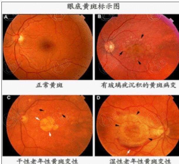 看一看武汉眼科医院老视手术要多少钱 其中个性化老视23600元+|老视22800元+|老视手术20000元+