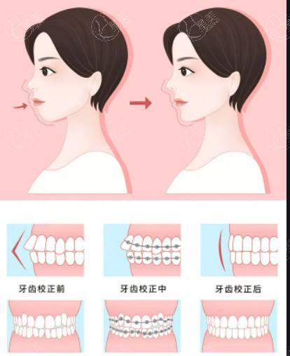 公布广州整形医院吸脂塑形整形要多少钱 吸脂瘦手臂/溶脂瘦小腿/肩部吸脂没想象的贵