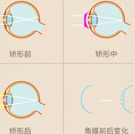 更新北京眼科医院白内障手术价格表更新 其中散光晶体价格14900起、连续视程晶体价格23000起